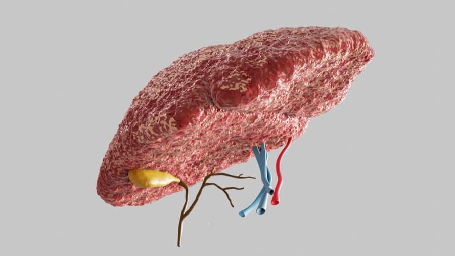 A visualization of a liver with nonalcoholic steatohepatitis (NASH)